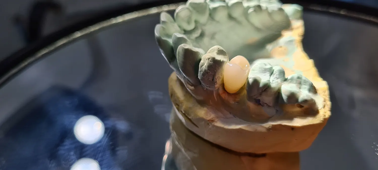 Modelo dental utilizado en trabajos de prótesis y estética dental en Ecodent